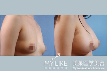 广州美莱携手粉红丝带开启活力乳房公益大普查活动