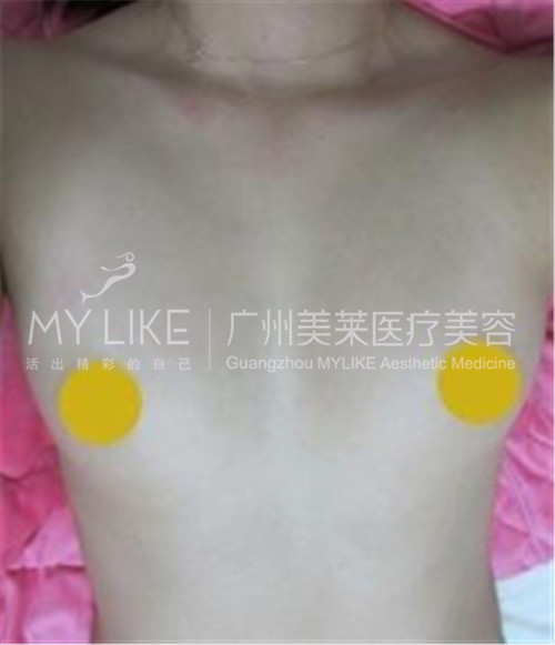 发一发我的隆胸日记，超有成就感哦1.jpg