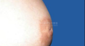 乳头凹陷1.png