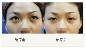 治疗黑眼圈案例一