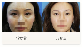 治疗黑眼圈案例一