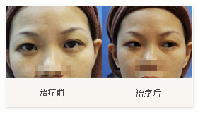 治疗黑眼圈案例一