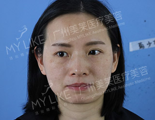 一个疗程 ― 侧面